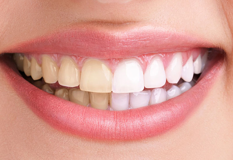 Lächelnder Mund mit Visualisierung des Bleechings