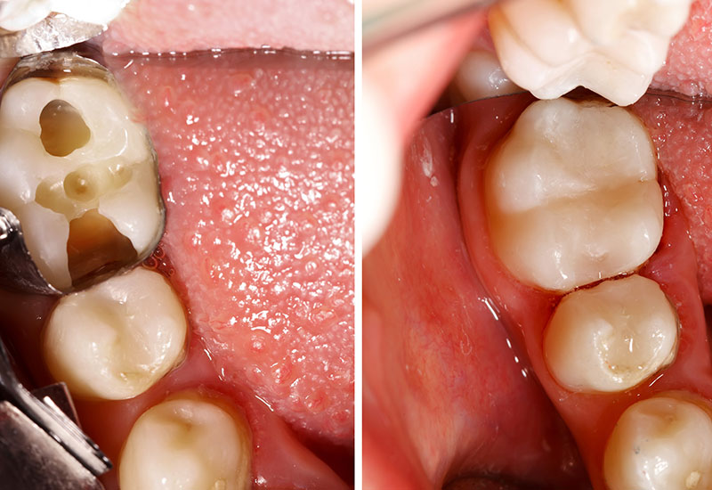 Vorher-Nachher Vergleich von Zähnen in Großaufnahme nach der Kunststofffüllung.