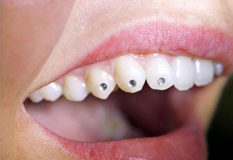 Ein geöffneter Frauenmund zeigt strahlend weiße Zähne mit Zahnschmuck in Großaufnahme.